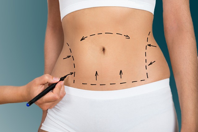 Cirujano plástico certificado por la junta |  Todo lo que debe saber sobre la abdominoplastia no quirúrgica |  Su belleza