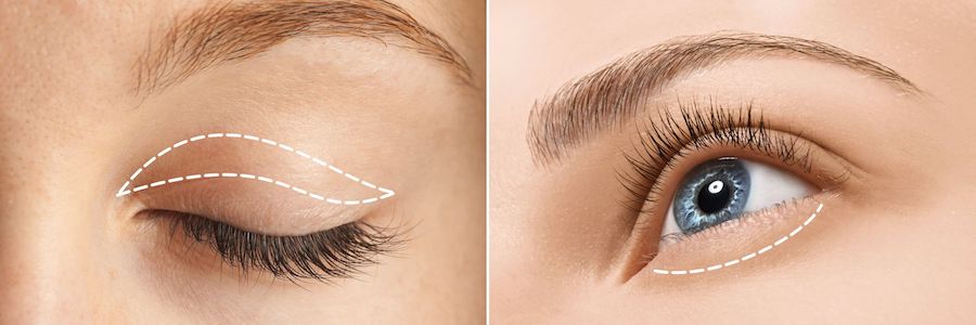 Cirugías Estéticas de Párpados |  Blefaroplastia: cirugía de párpados para una apariencia más fresca y joven |  Su belleza