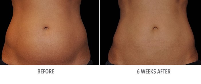 Los resultados no son inmediatos |  Qué hacer y qué no hacer con Coolsculpting |  Su belleza