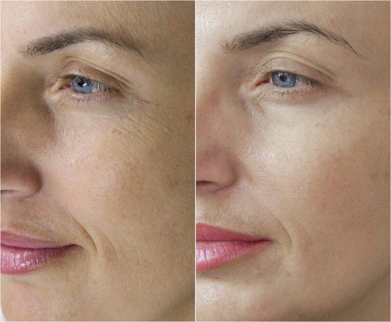 Microneedling antes y después |  Todo lo que hay que saber sobre las microagujas |  Su belleza