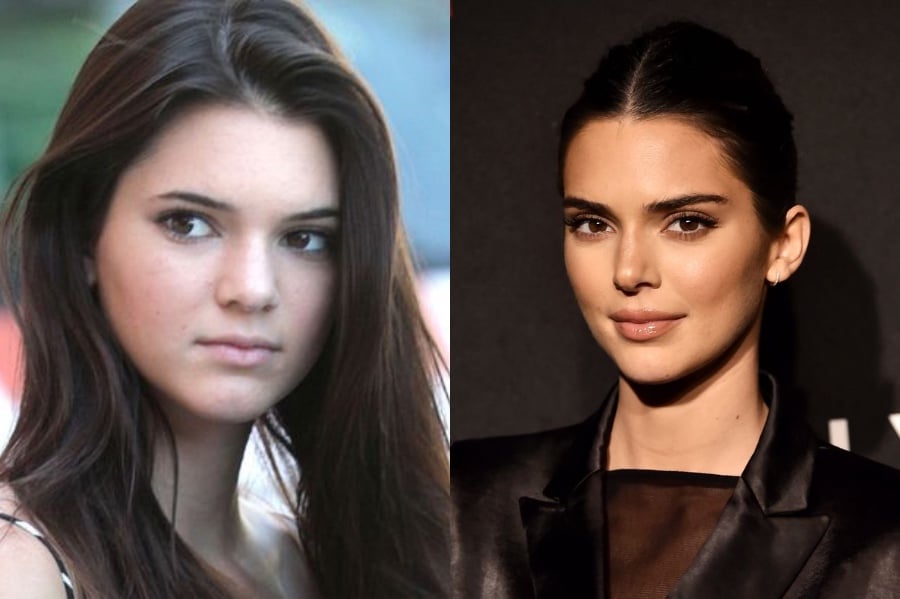 Cirugía Plástica de Kendall Jenner |  7 datos jugosos sobre Kendall Jenner |  Su belleza